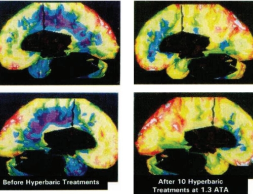 HBOT & Impaired Brain Function